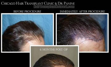 Hair transplantation surgery before and after images