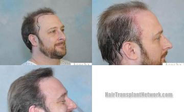 Hair transplantation surgery before and after images