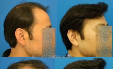 Hair transplantation surgery before and after images