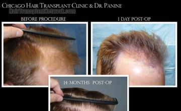 Hair transplantation surgery before and after images