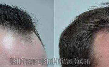 Hair transplantation surgery before and after photos