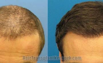 Tilt down view before and after hair transplant