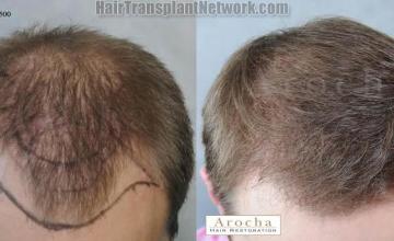 Hair restoration procedure before and after results