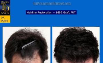 Hair transplantation surgery before and after photos