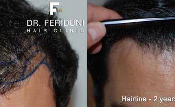 Hair restoration surgery before and after images