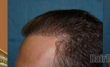 Hair restoration procedure results