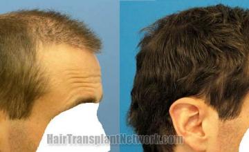 Right view before and after hair restoration