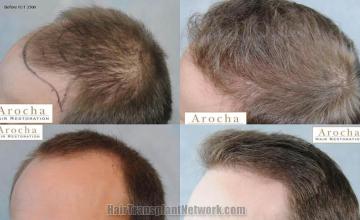 Hair transplantation surgery before and after images