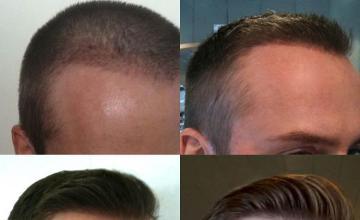 Hair transplantation surgery before and after images