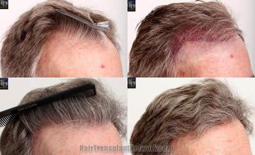 Hair transplantation surgery before and after photos