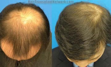 Hair transplantation surgery before and after photos