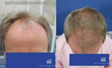 Hair transplantation surgery before and after images