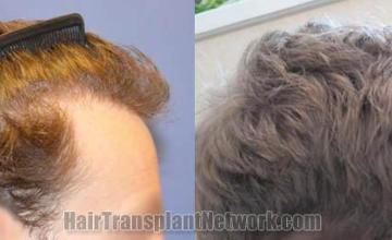 Hair transplantation surgery before and after images