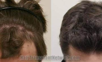 Top view before and after hair restoration results