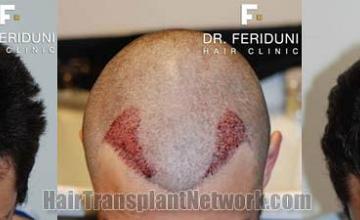 Top view before and after hair restoration results