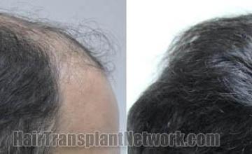 Hair transplantation surgery before and after images