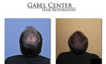 Surgical hair transplantation result photographs