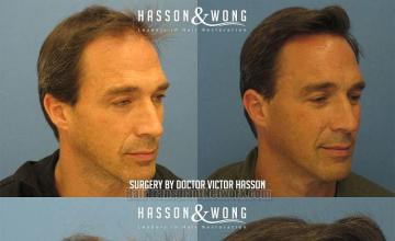 Hair transplant surgery before and after images