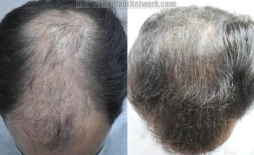 Hair transplantation surgery before and after photos