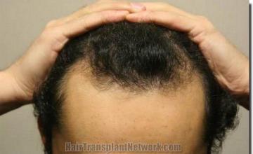 Hair restoration procedure results