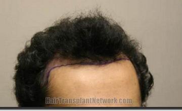 Hair restoration procedure results