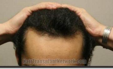 Hair restoration procedure results