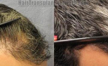 Hair transplantation surgery before and after pictures