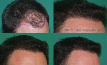 Hair restoration procedure before and after results