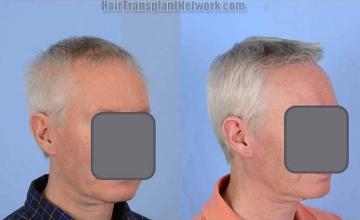 Hair restoration procedure before and after results