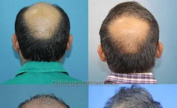 Surgical hair transplantation result photographs