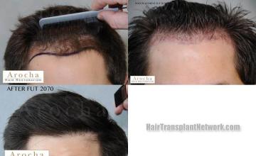 Hair transplantation surgery before and after photos