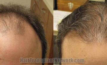 Front view - Before and after
