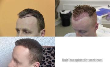 Hair transplantation surgery before and after images