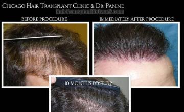 Hair transplantation surgery before and after pictures