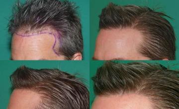 Hair transplantation surgery before and after images