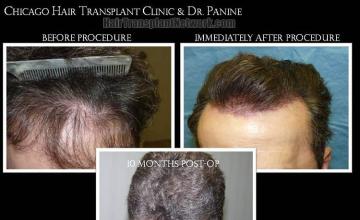 Hair restoration procedure before and after results