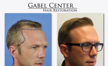 Hair transplantation surgery before and after images