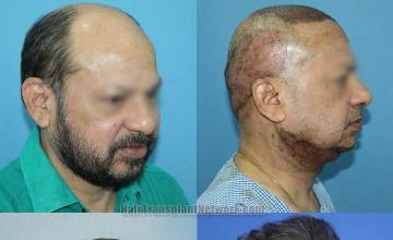 Hair restoration procedure after result images