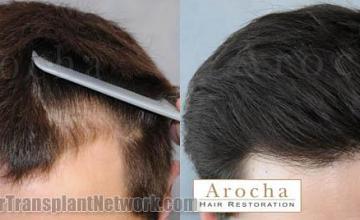 Hair transplantation surgery before and after images