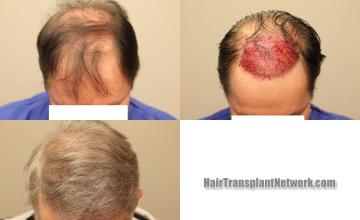 Before and after hair restoration procedure images