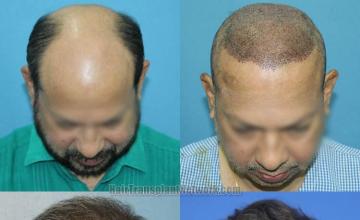 Before and after hair restoration procedure images