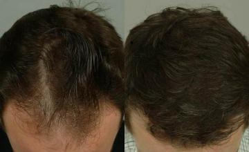 Hair restoration procedure before and after pictures