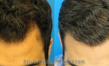 Top view before and after hair restoration results