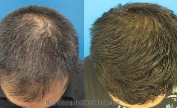 Top view before and after hair restoration results