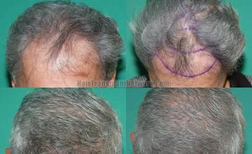 Top view before and after hair restoration results