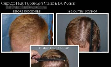 Hair transplantation surgery before and after photos