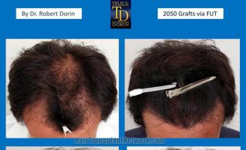 Hair transplantation surgery before and after photos