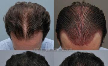 Hair restoration procedure before and after results