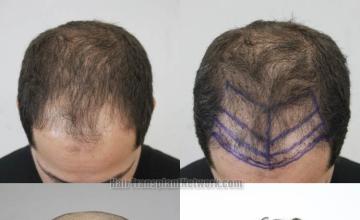 Hair restoration procedure before and after results