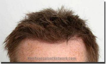 Hair restoration procedure results